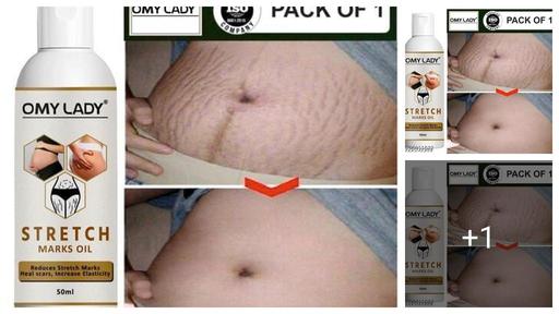 Useful Stretch Marks And Scars Creams & Oils